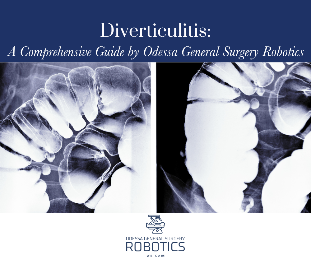 Diverticulitis: A Comprehensive Guide by Odessa General Surgery Robotics